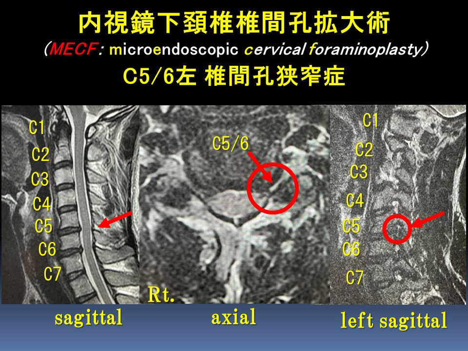 MECF05/6