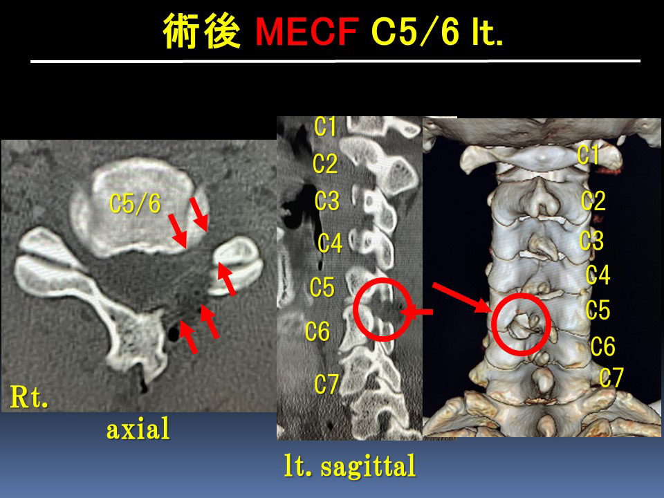 MECF05/6